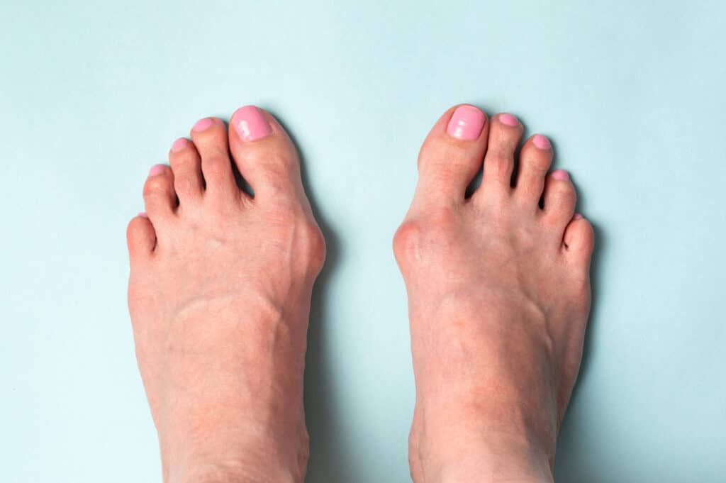 image of feet with bone on the foot disease