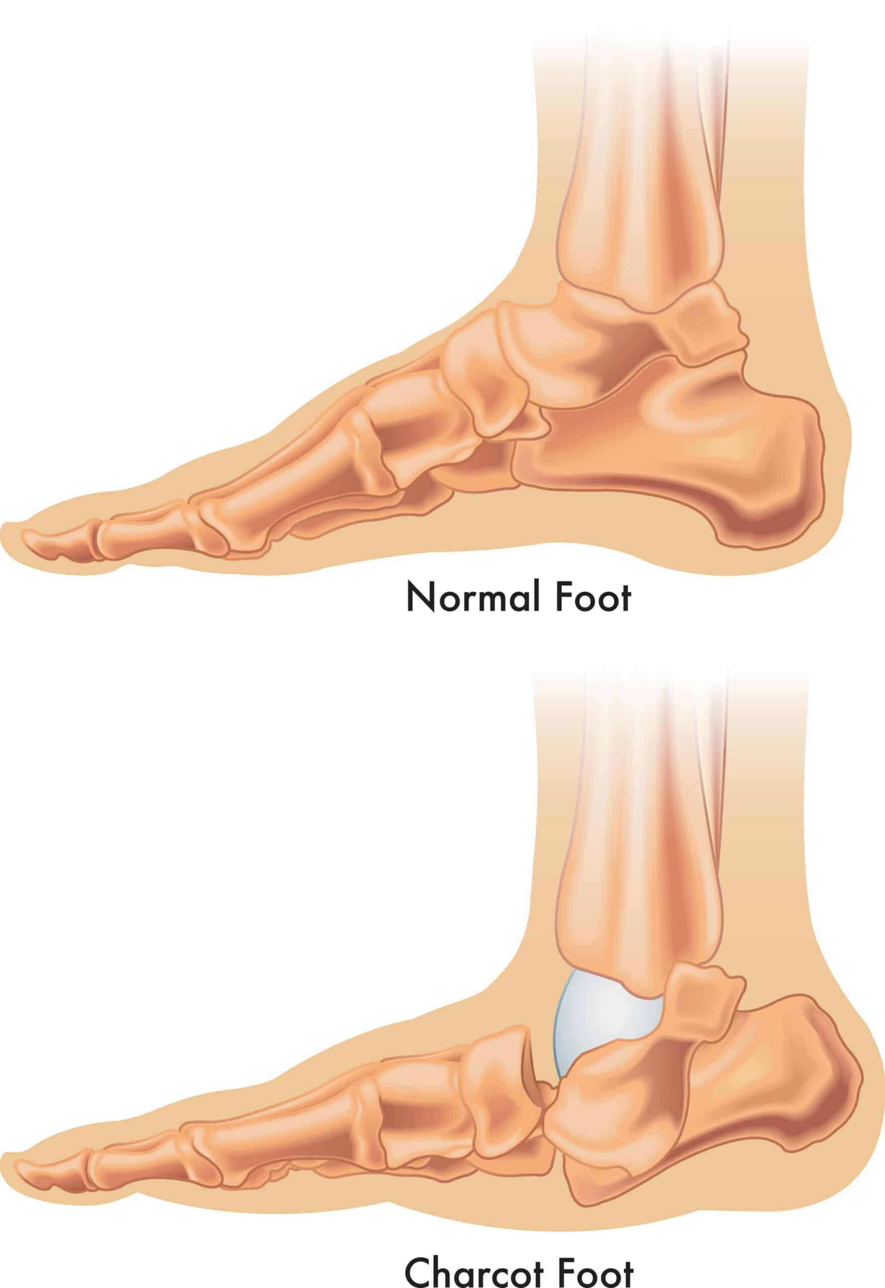 bottom foot tendons