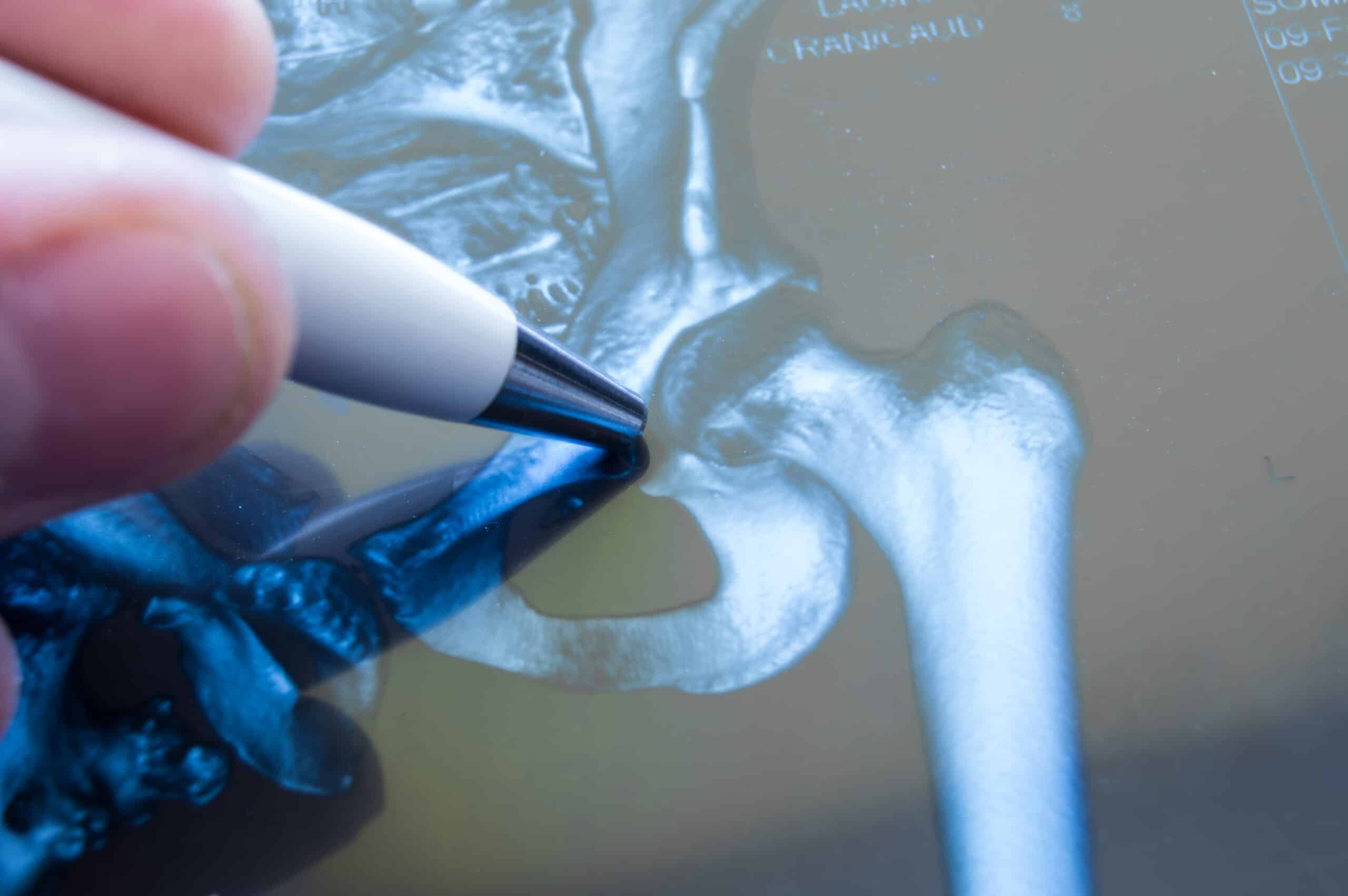 Femoroacetabular Impingement (FAI) - Orthopedic Solutions OKC