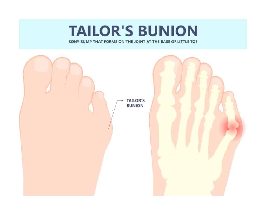 illustration of tailor's bunion